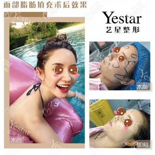 深圳藝星脂肪填充效果對(duì)比