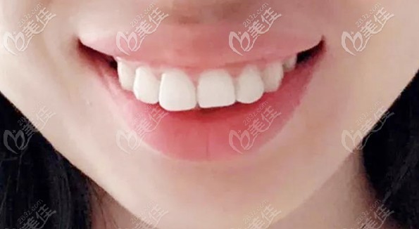 青島馬瀧齒科做牙齒矯正的張晗醫(yī)生案例