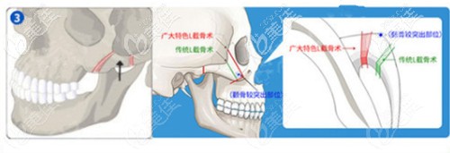 柳超做顴骨整形的優(yōu)勢(shì)