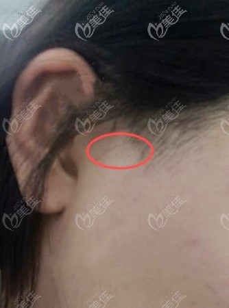 顴骨內(nèi)推手術(shù)耳前切口恢復(fù)效果