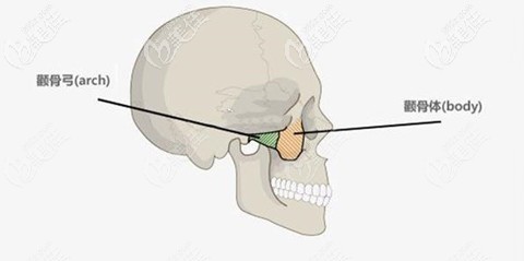 顴骨內(nèi)推手術(shù)會留疤嗎？