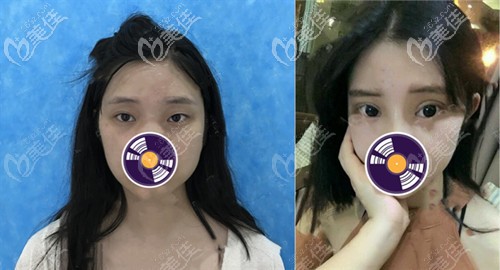 瀘州花都雙眼皮案例