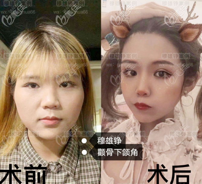 <!--<i data=20240703-sp></i>-->顴骨內(nèi)推下頜角手術(shù)<span style= <!--<i data=20240703-sp></i>-->顴骨內(nèi)推下頜角手術(shù)<span style=