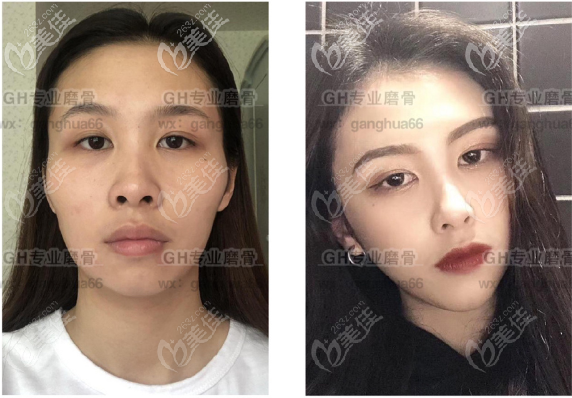 磨骨技術(shù)怎么樣？從磨骨案例來看磨骨磨的不多風(fēng)格自然價(jià)格不貴