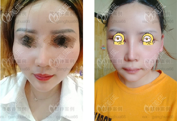 <!--<i data=20240703-sp></i>-->顴骨手術(shù)做得好 <!--<i data=20240703-sp></i>-->顴骨手術(shù)做得好