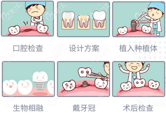 青島馬瀧齒科的種植牙過程圖解