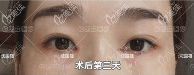 沈國雄眼修復(fù)案例術(shù)后第三天