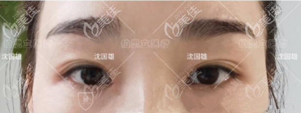 沈國雄雙眼皮修復(fù)怎么樣？內(nèi)眼角開大找他做修復(fù)縮小