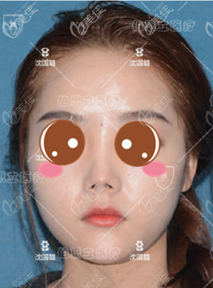 <!--<i data=20240703-sp></i>-->伯思立沈國雄鼻修復真人案例術前正面照 <!--<i data=20240703-sp></i>-->伯思立沈國雄鼻修復真人案例術前正面照