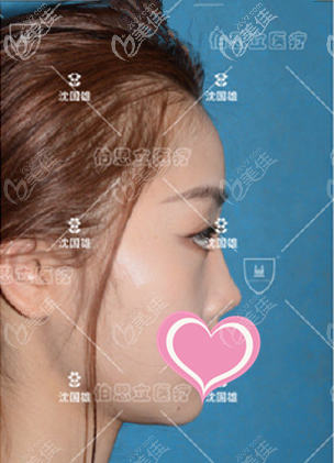 <!--<i data=20240703-sp></i>-->伯思立沈國雄鼻修復真人案例術前側面照 <!--<i data=20240703-sp></i>-->伯思立沈國雄鼻修復真人案例術前側面照