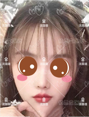 兩次隆鼻修復(fù)失敗怎么辦？沈國雄將我攣縮后出現(xiàn)的小豬鼻修復(fù)好了