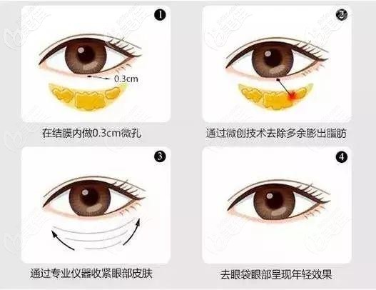 南京美貝爾做不開(kāi)刀祛眼袋