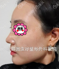在韓國汝好整形外科做耳軟鼻綜合沒有我想的那么疼