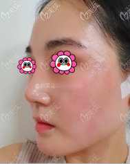 在韓國做的耳軟骨鼻綜合案例