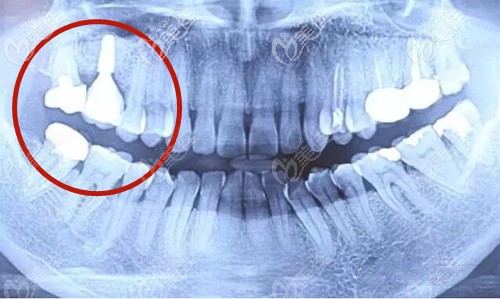 威高種植牙一年效果