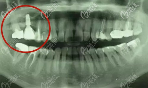 威高種植牙五年效果