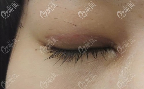 雙眼皮刀口凹陷圖片