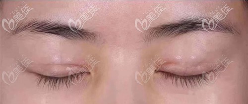 雙眼皮刀口凹陷疤痕