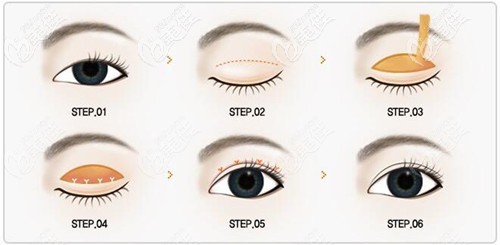 雙眼皮修復(fù)手術(shù)過(guò)程