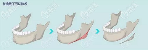長(zhǎng)曲線下頜角手術(shù)價(jià)格