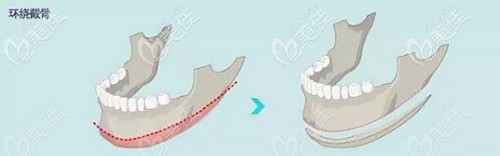 下頜角環(huán)切的效果大嗎