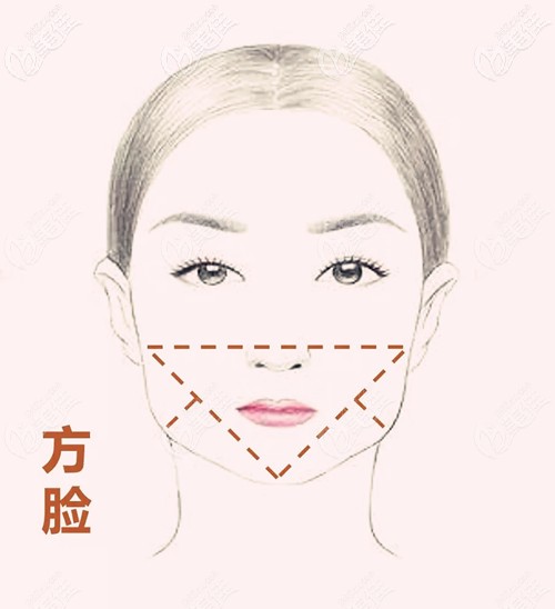 下頜角手術(shù)的適應(yīng)人群