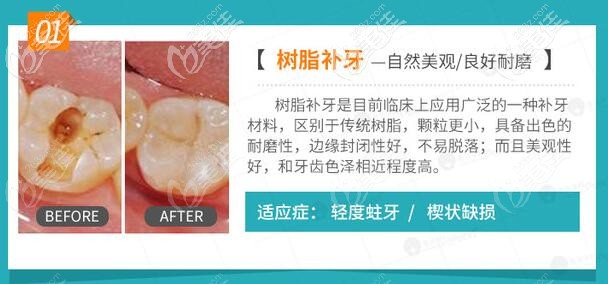 樹脂補牙好處