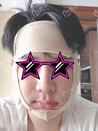 下頜角手術(shù)后戴頭套照片 下頜角手術(shù)后戴頭套照片