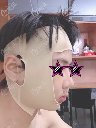 削骨手術(shù)后包扎樣子 削骨手術(shù)后包扎樣子