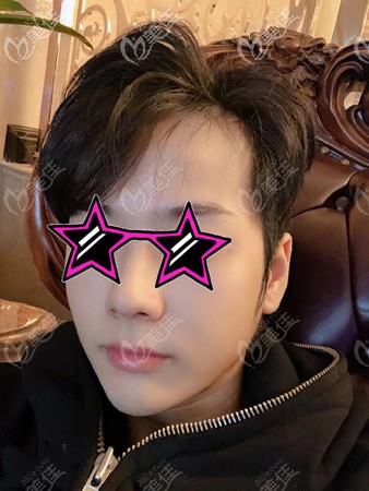 男生下頜角手術(shù)案例:從國字臉做削骨前后對比效果看,臉終于不方了