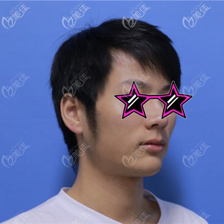 側(cè)面下頜骨肥大很難看 側(cè)面下頜骨肥大很難看