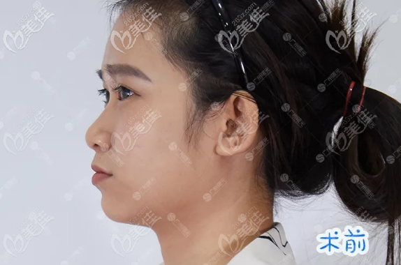 廣州曙光雙側(cè)耳軟骨隆鼻術(shù)前照片 廣州曙光雙側(cè)耳軟骨隆鼻術(shù)前照片
