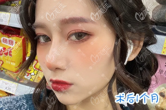 瞧雙側(cè)耳軟骨鼻綜合做出來(lái)的鼻子怎么樣?內(nèi)附雙側(cè)耳軟骨鼻綜合恢復(fù)效果圖