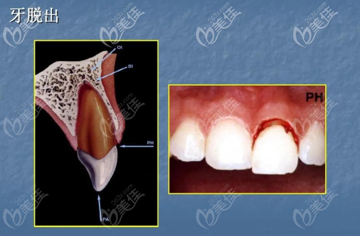 牙脫位
