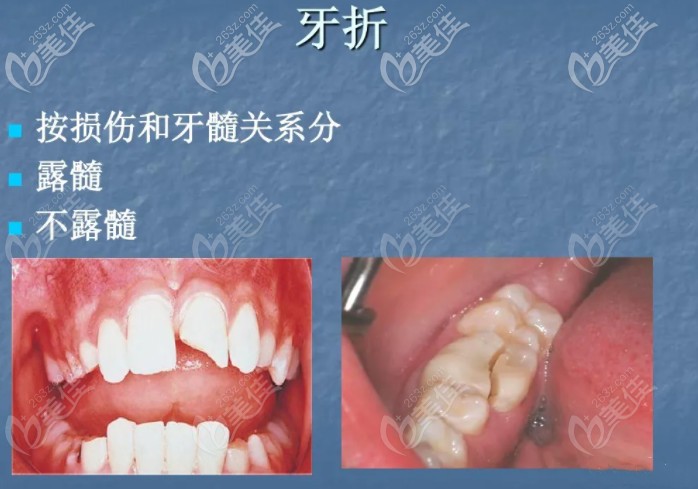 牙折