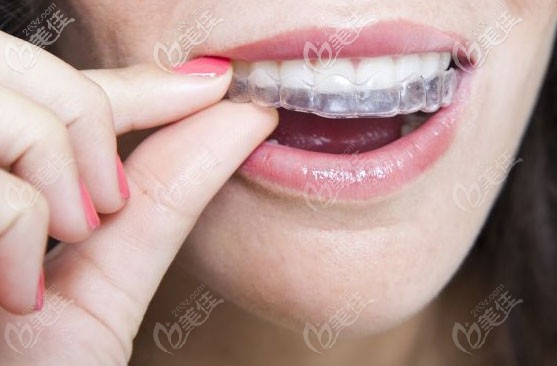 隱形牙套試戴效果圖