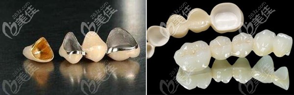 烤瓷牙全瓷牙對比
