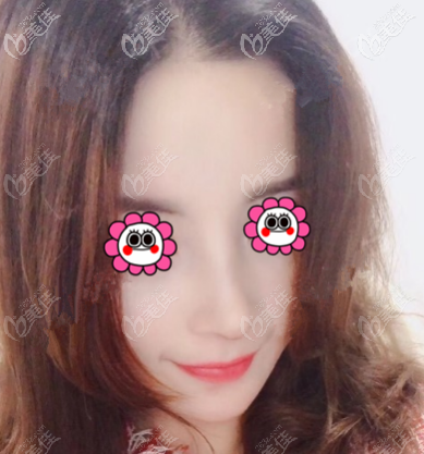 北京壹加壹歪鼻矯正案例快一個月樣子