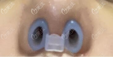 鼻假體取出戴鼻孔支撐器防止攣縮