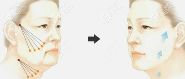 埋線提升術前術后變化圖 埋線提升術前術后變化圖