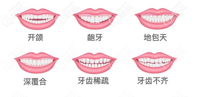 牙齒矯正適應(yīng)癥 牙齒矯正適應(yīng)癥