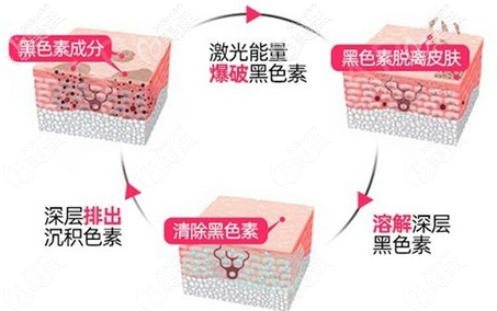 超皮秒去黑眼圈過(guò)程示意圖
