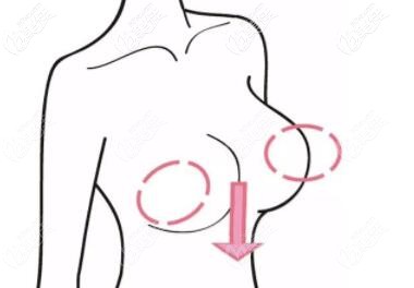 減肥過(guò)度導(dǎo)致胸部下垂怎么辦