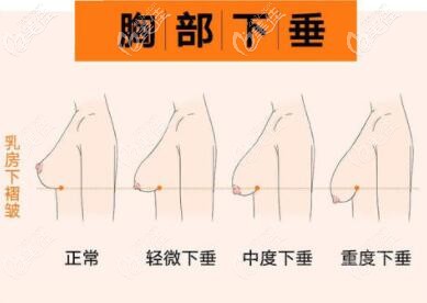 胸部下垂的等級(jí)示意圖