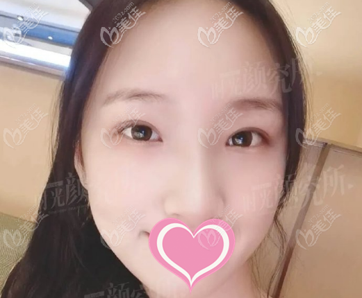 <!--<i data=20240703-sp></i>-->時(shí)光許黎平全切雙眼皮案例術(shù)后四個(gè)月