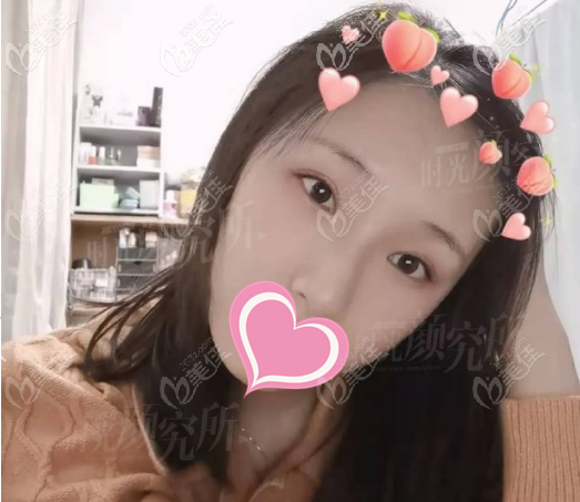 想看許黎平醫(yī)生雙眼皮案例戳這里，觀摩她做全切雙眼皮恢復過程圖