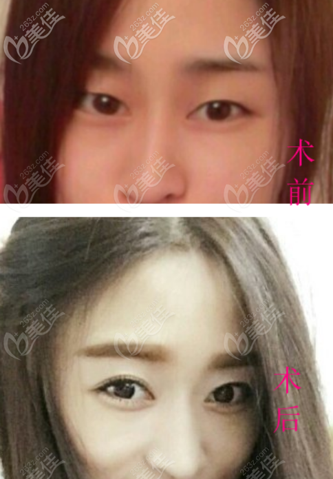 <!--<i data=20240703-sp></i>-->張筠莉醫(yī)生雙眼皮案例二 <!--<i data=20240703-sp></i>-->張筠莉醫(yī)生雙眼皮案例二