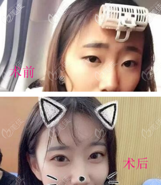 用案例談張?bào)蘩蜥t(yī)生做雙眼皮怎么樣？擅長(zhǎng)什么手術(shù)風(fēng)格的雙眼皮？