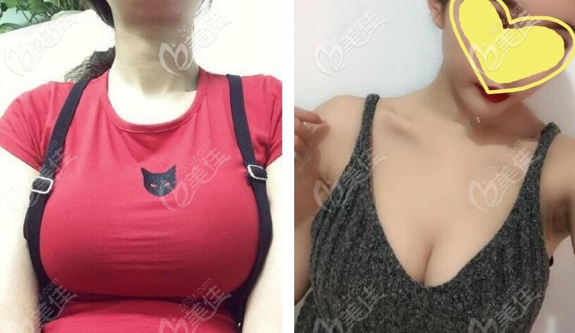 縮胸手術(shù)+乳房提升一年后效果圖片