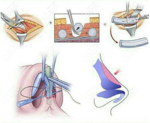 李攀醫(yī)生肋軟骨隆鼻